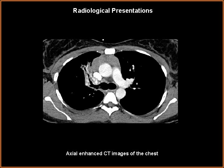 Radiological Presentations Axial enhanced CT images of the chest 