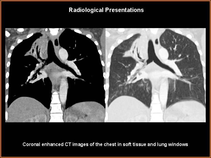 Radiological Presentations Coronal enhanced CT images of the chest in soft tissue and lung