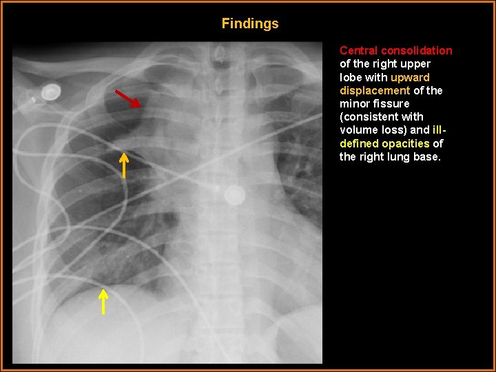 Findings Central consolidation of the right upper lobe with upward displacement of the minor
