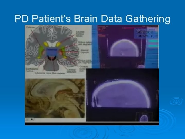 PD Patient’s Brain Data Gathering 