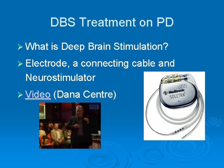 DBS Treatment on PD What is Deep Brain Stimulation? Electrode, a connecting cable and
