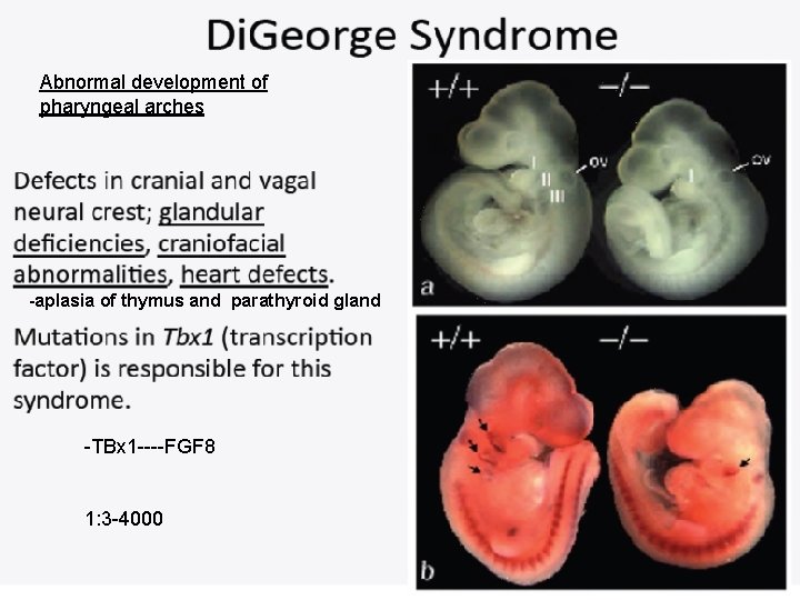 Abnormal development of pharyngeal arches -aplasia of thymus and parathyroid gland -TBx 1 ----FGF