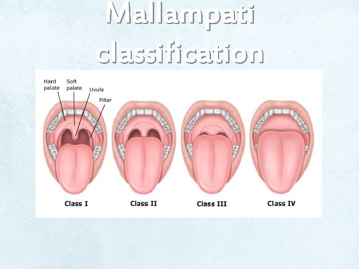 Mallampati classification Mallampati classification