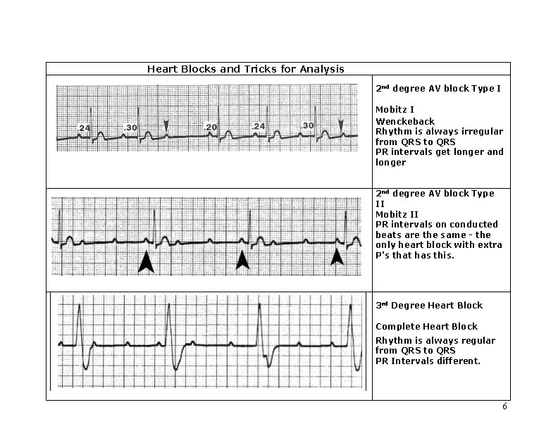 Heart Blocks and Tricks for Analysis 2 nd degree AV block Type I Mobitz