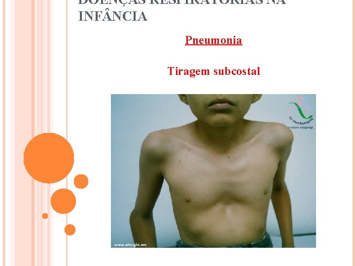 DOENÇAS RESPIRATÓRIAS NA INF NCIA Pneumonia Tiragem subcostal 