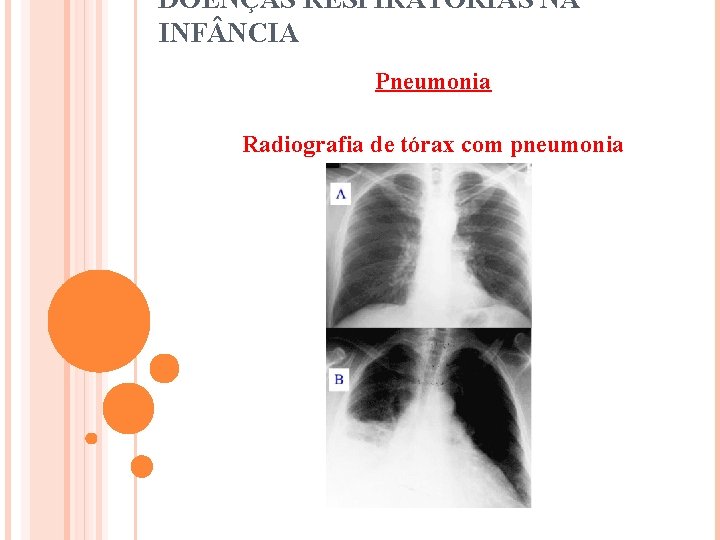 DOENÇAS RESPIRATÓRIAS NA INF NCIA Pneumonia Radiografia de tórax com pneumonia 