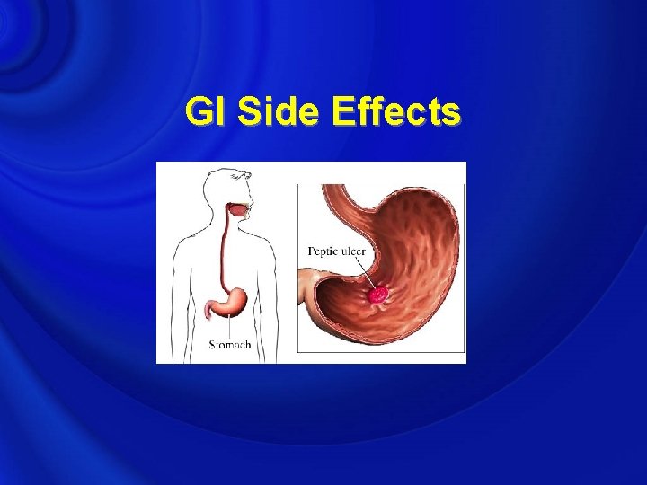GI Side Effects 