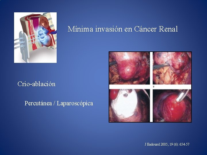 Mínima invasión en Cáncer Renal Crio-ablación Percutánea / Laparoscópica J Endourol 2005; 19 (6):