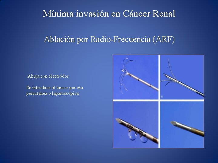 Mínima invasión en Cáncer Renal Ablación por Radio-Frecuencia (ARF) Ahuja con electródos Se introduce