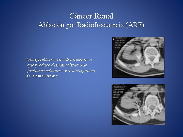 Cáncer Renal Ablación por Radiofrecuencia (ARF) Energía eléctrica de alta frecuencia que produce desnaturalizació