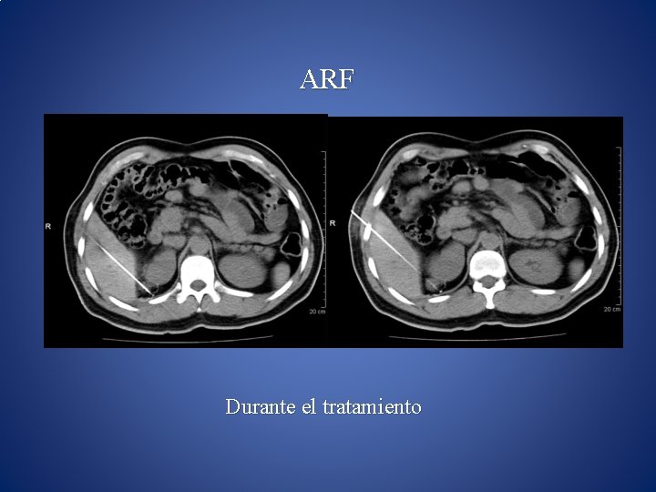 ARF Durante el tratamiento 