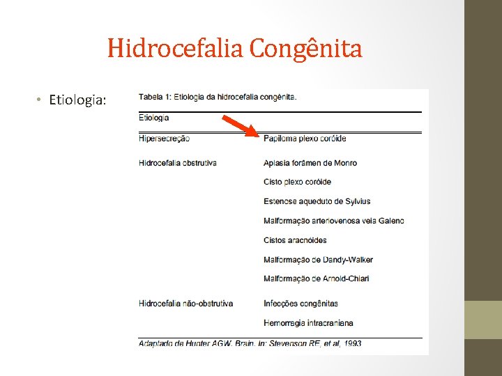 Hidrocefalia Congênita • Etiologia: 