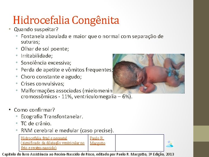 Hidrocefalia Congênita • Quando suspeitar? • Fontanela abaulada e maior que o normal com