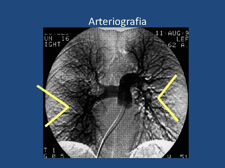 Arteriografia Arteriografia