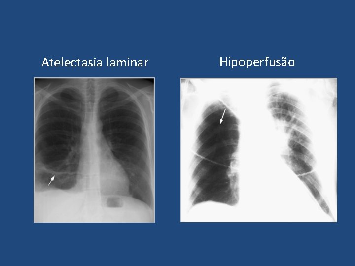 Atelectasia laminar Hipoperfusão Atelectasia laminar Hipoperfusão