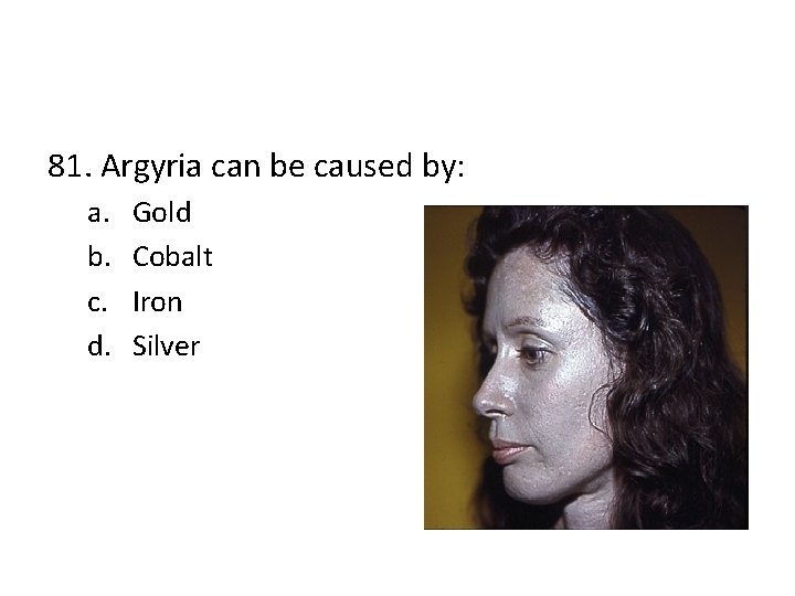 81. Argyria can be caused by: a. b. c. d. Gold Cobalt Iron Silver