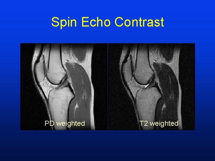 Spin Echo Contrast PD weighted T 2 weighted 