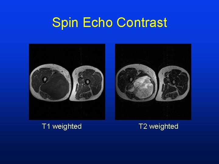 Spin Echo Contrast T 1 weighted T 2 weighted 