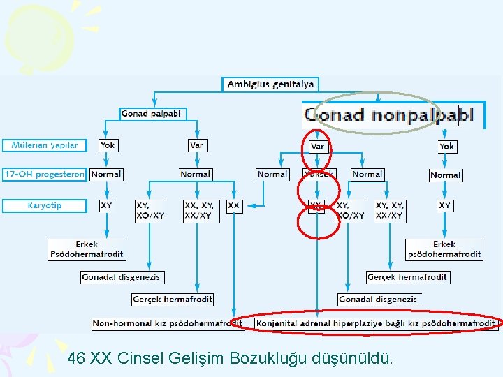 46 XX Cinsel Gelişim Bozukluğu düşünüldü. 