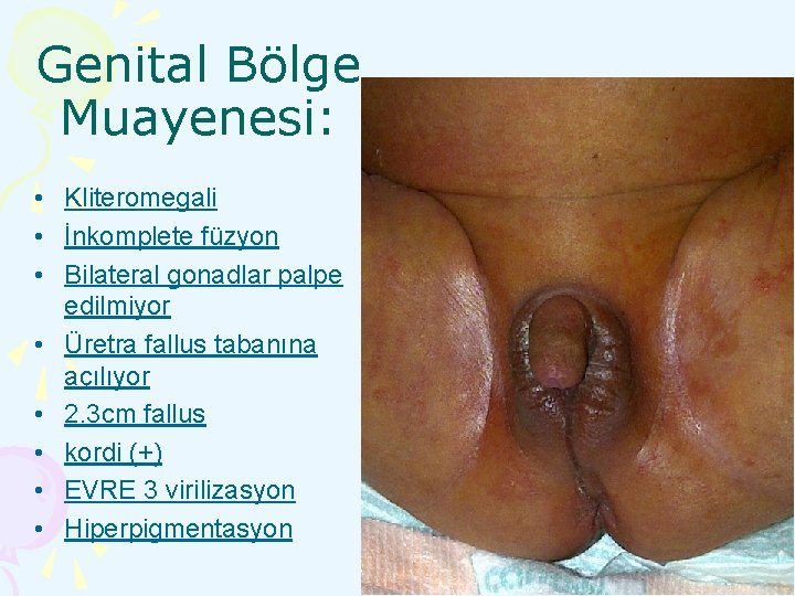 Genital Bölge Muayenesi: • Kliteromegali • İnkomplete füzyon • Bilateral gonadlar palpe edilmiyor •