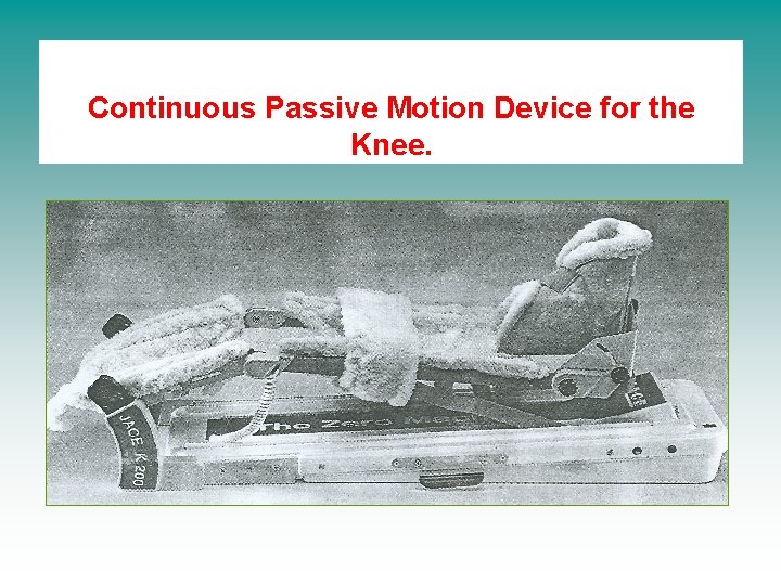 Continuous Passive Motion Device for the Knee. 