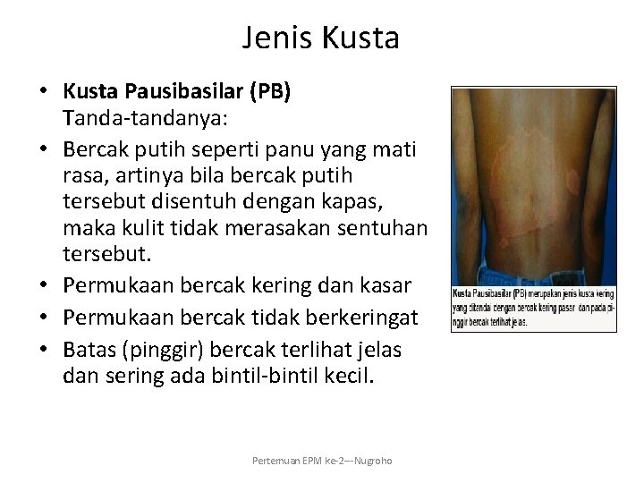 Jenis Kusta • Kusta Pausibasilar (PB) Tanda-tandanya: • Bercak putih seperti panu yang mati