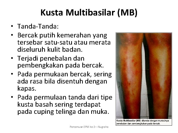 Kusta Multibasilar (MB) • Tanda-Tanda: • Bercak putih kemerahan yang tersebar satu-satu atau merata