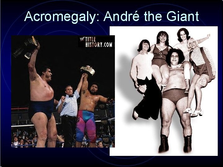 Acromegaly: André the Giant 