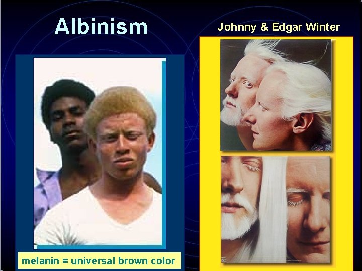 Albinism melanin = universal brown color Johnny & Edgar Winter 