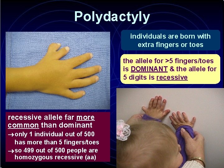 Polydactyly individuals are born with extra fingers or toes the allele for >5 fingers/toes