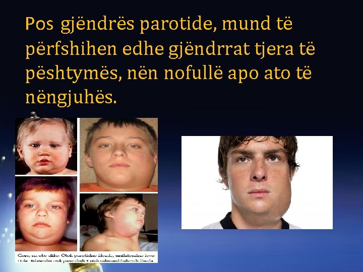 Pos gjëndrës parotide, mund të përfshihen edhe gjëndrrat tjera të pështymës, nën nofullë apo