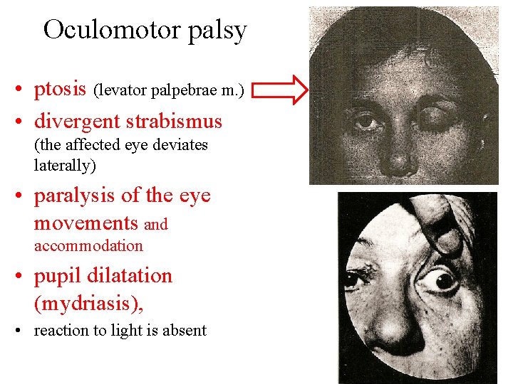 Oculomotor palsy • ptosis (levator palpebrae m. ) • divergent strabismus (the affected eye