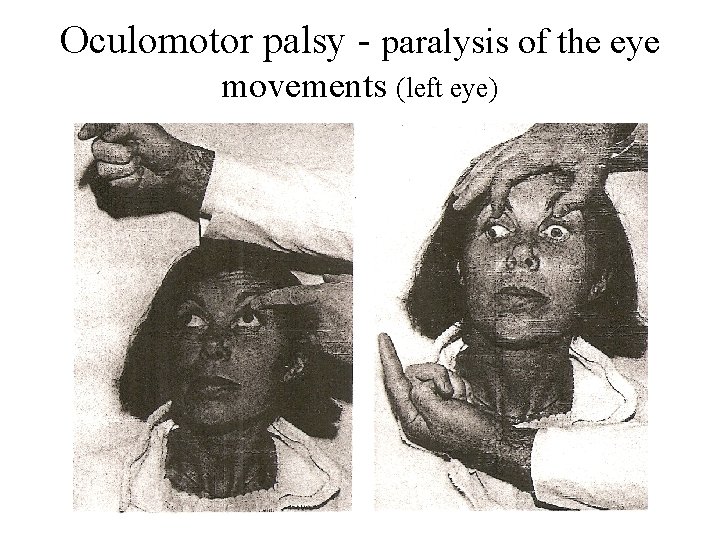 Oculomotor palsy - paralysis of the eye movements (left eye) 