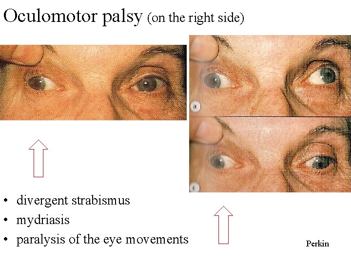 Oculomotor palsy (on the right side) • divergent strabismus • mydriasis • paralysis of Oculomotor palsy (on the right side) • divergent strabismus • mydriasis • paralysis of
