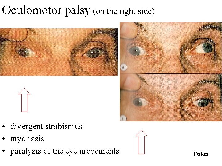 Oculomotor palsy (on the right side) • divergent strabismus • mydriasis • paralysis of