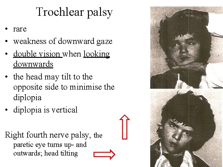 Trochlear palsy • rare • weakness of downward gaze • double vision when looking Trochlear palsy • rare • weakness of downward gaze • double vision when looking