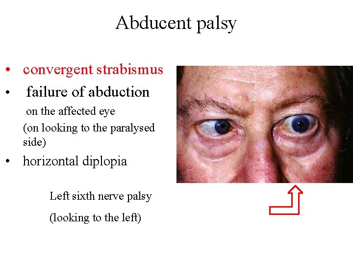 Abducent palsy • convergent strabismus • failure of abduction on the affected eye (on Abducent palsy • convergent strabismus • failure of abduction on the affected eye (on