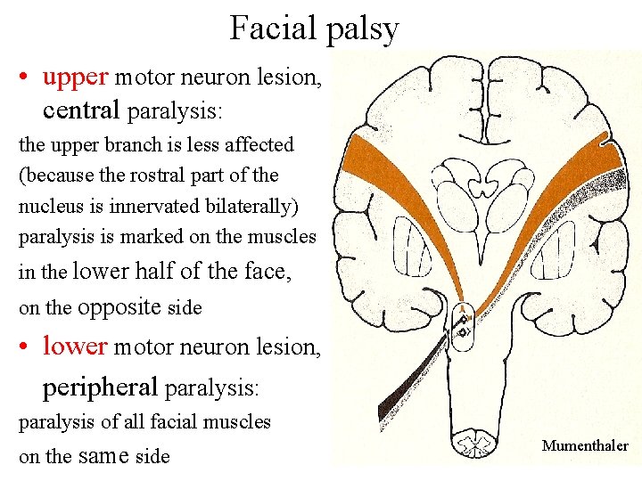 Facial palsy • upper motor neuron lesion, central paralysis: the upper branch is less