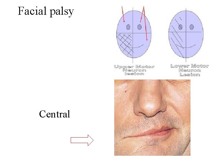 Facial palsy Central Facial palsy Central