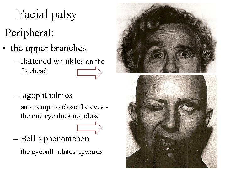 Facial palsy Peripheral: • the upper branches – flattened wrinkles on the forehead – Facial palsy Peripheral: • the upper branches – flattened wrinkles on the forehead –