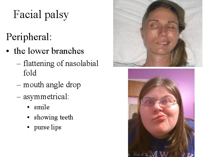 Facial palsy Peripheral: • the lower branches – flattening of nasolabial fold – mouth Facial palsy Peripheral: • the lower branches – flattening of nasolabial fold – mouth