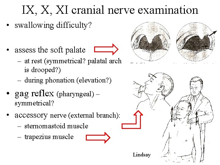 IX, X, XI cranial nerve examination • swallowing difficulty? • assess the soft palate