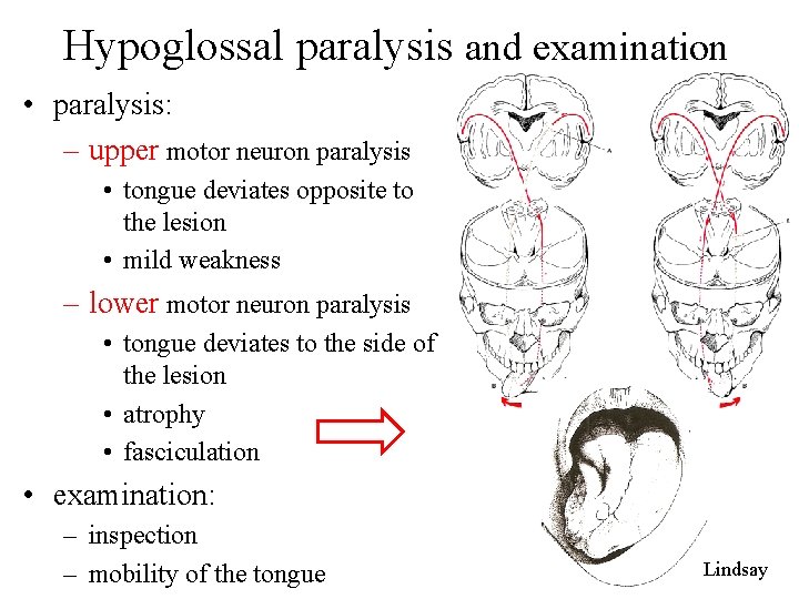 Hypoglossal paralysis and examination • paralysis: – upper motor neuron paralysis • tongue deviates Hypoglossal paralysis and examination • paralysis: – upper motor neuron paralysis • tongue deviates