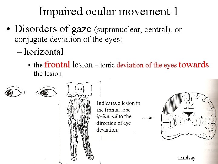 Impaired ocular movement 1 • Disorders of gaze (supranuclear, central), or conjugate deviation of