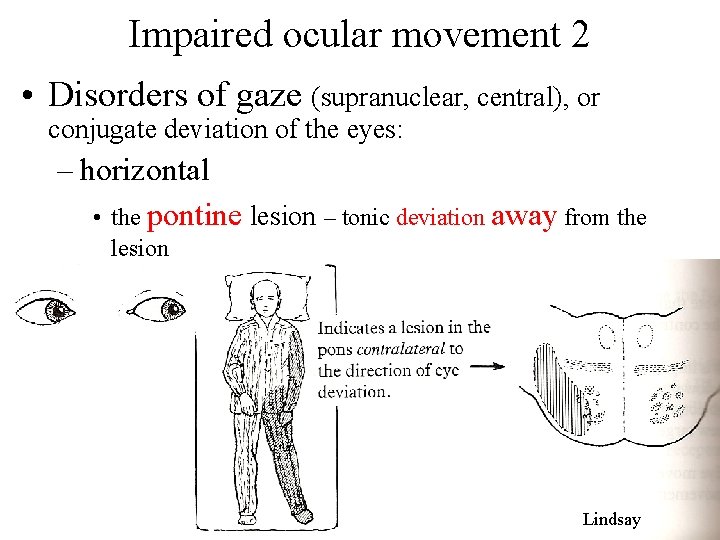 Impaired ocular movement 2 • Disorders of gaze (supranuclear, central), or conjugate deviation of Impaired ocular movement 2 • Disorders of gaze (supranuclear, central), or conjugate deviation of
