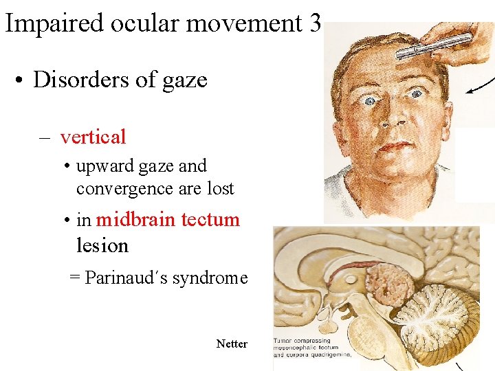 Impaired ocular movement 3 • Disorders of gaze – vertical • upward gaze and