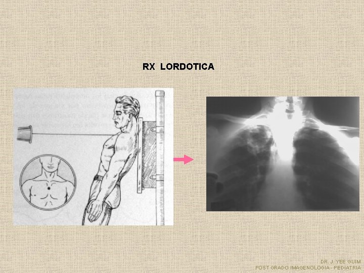 RX LORDOTICA DR. J. YEE GUIM POST GRADO IMAGENOLOGIA - PEDIATRIA 