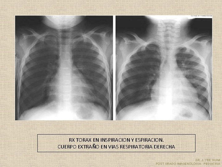 RX TORAX EN INSPIRACION Y ESPIRACION. CUERPO EXTRAÑO EN VIAS RESPIRATORIA DERECHA DR. J.