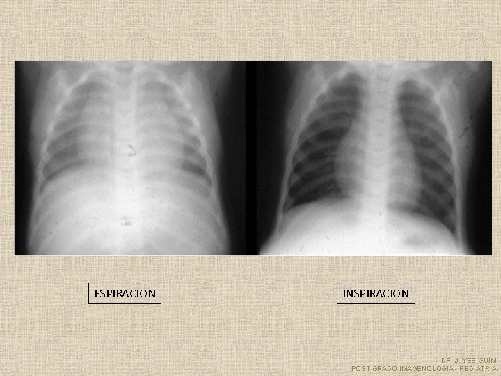 ESPIRACION INSPIRACION DR. J. YEE GUIM POST GRADO IMAGENOLOGIA - PEDIATRIA 