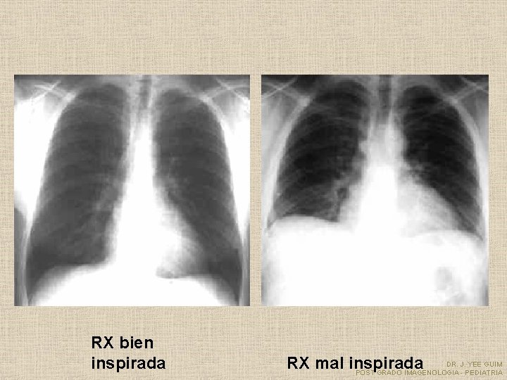 RX bien inspirada DR. J. YEE GUIM RX mal inspirada POST GRADO IMAGENOLOGIA -